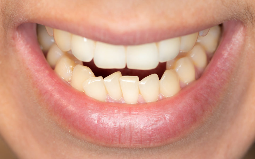 Perfecting Your Smile: How to Fix Crooked Teeth Quickly